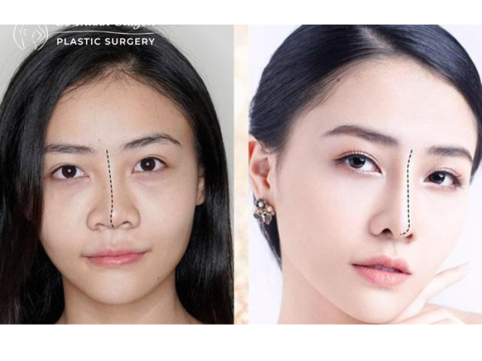 Nâng mũi phong thủy là gì? Có nên nâng mũi phong thủy hay không?