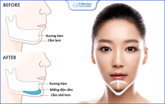 Mặt V line là gì? Bí quyết để sở hữu khuôn mặt đẹp chuẩn V Line